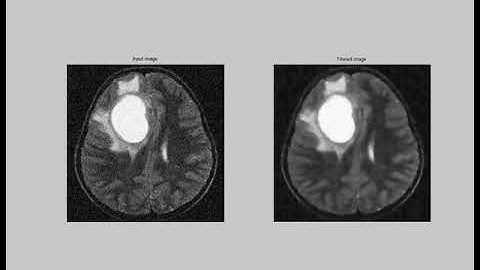 Brain Tumor Segmentation using Convolutional Neural Networks in MRI Images