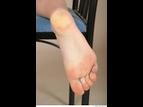 best treatment for bruised heel