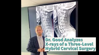 Dr. Good Analyzes X-rays of a Three-Level Hybrid Cervical Surgery