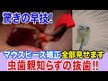 【親知らず抜歯】痛い?歯医者が親知らずを抜く瞬間全て見せます!