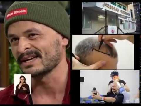 Deamed - სოსო ხვედელიძემ კლინიკა დეამედში თმა გადაინერგა