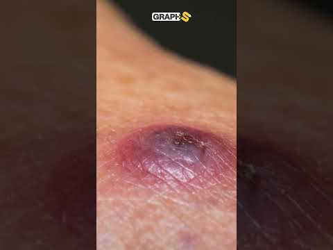 ذبابة الرمل تفتك بالجنود الإسرائيليين