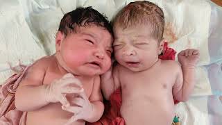 Chubby Twins Newborn babies just after birth born to a diabetic mother,, look at those Cheeks ❤️