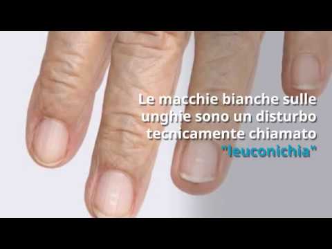 Video: Macchie Bianche Sulle Unghie - Cause E Trattamento