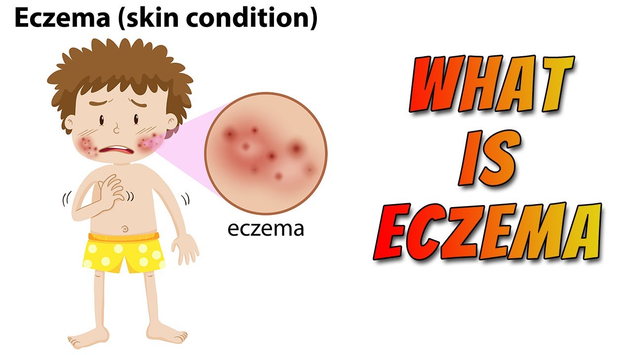 What is Eczema Its Types Clinical Manifestation Diagnosis
