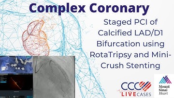 Staged PCI of Calcified LAD/D1 Bifurcation using RotaTripsy and Mini-Crush Stenting