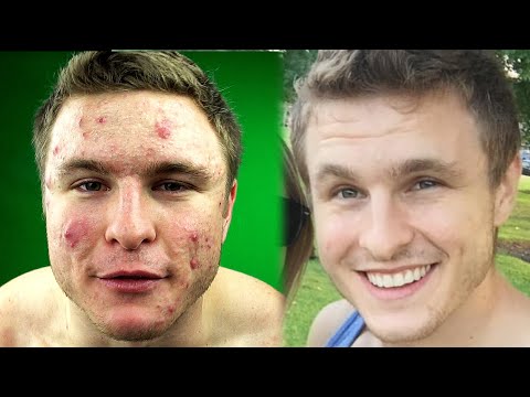 Things People With Acne Can Relate To! | #TeamAcne