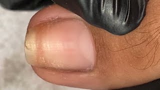 Pasukan na ulit kaya naman pedicure na mahaba na kuko fypシ ingrown_toenail pedicure satisfying