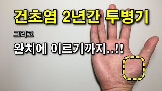 [건초염] 엄지손가락 건초염 2년간의 투병기 및 완치에 이르는 방법!!(가정에서 치료가능!!)