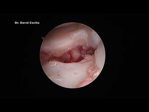PSEUDOARTROSIS DE ESCAFOIDES. TRATAMIENTO ARTROSCÓPICO