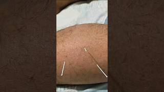 #dryneedling #calfmuscles #pain #stiffness #triggerpoint #physiotherapy #viral