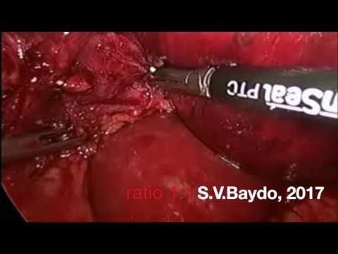 Laparoscopic anatomic S2 liver resection