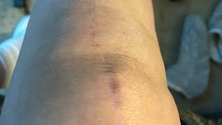 My knee replacement journey - final video - 1 year anniversary!