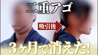 【脂肪吸引】自分の顔写真がイヤで仕方ない… 丸顔…のサムネイル