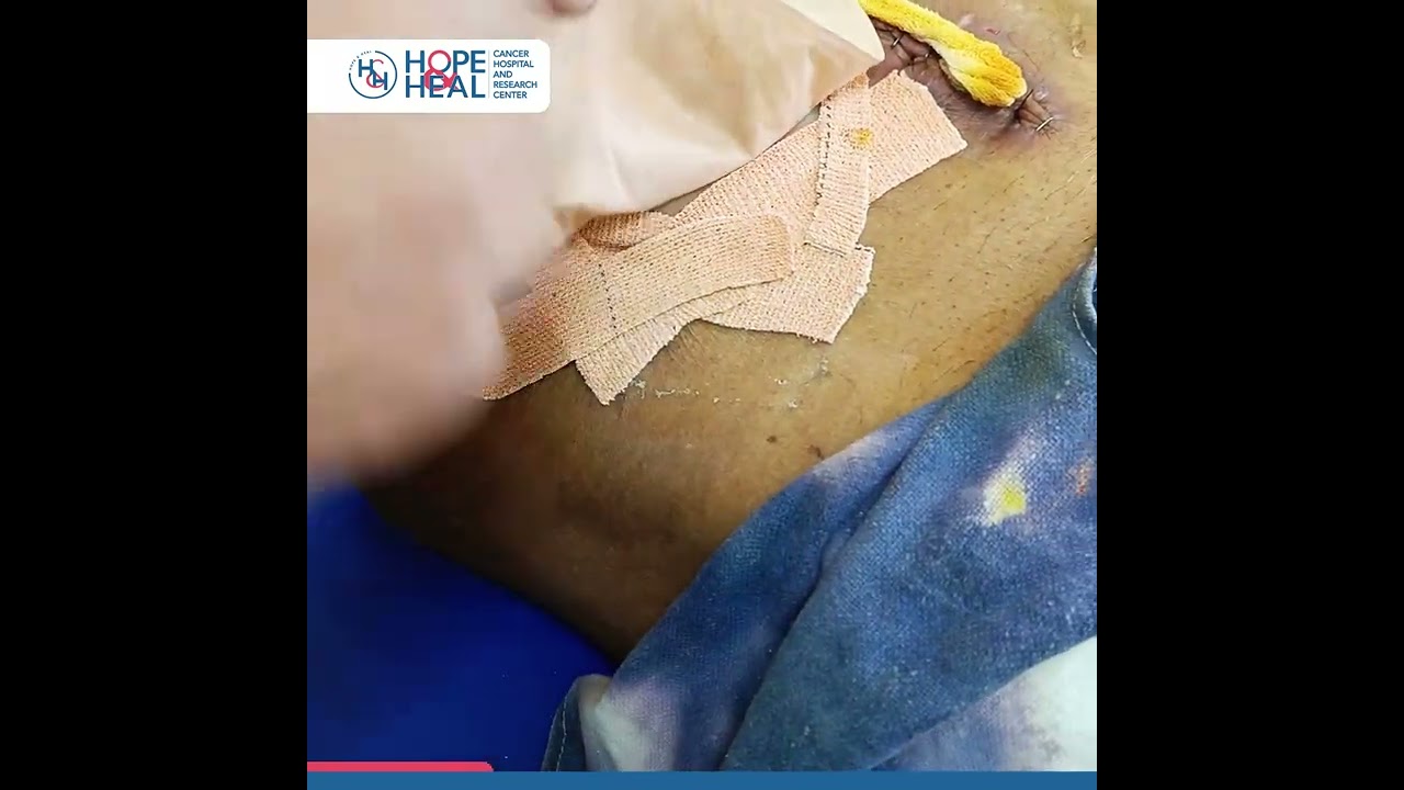 Expert Guide: Proper Application & Management of Stoma Bags with Dr. Sudip Haldar