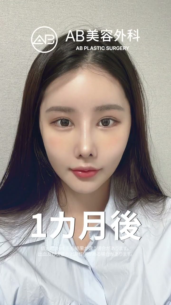 1分でわかる整形マジック #韓国整形 #整形ビフォーアフター #おすすめ