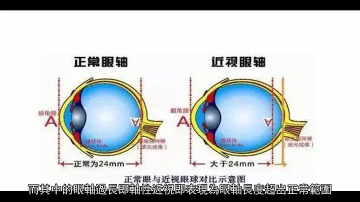 近視手術能解決眼睛變形、眼球突出嗎？ - 天天要聞