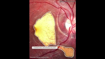 Choroidal Rupture - Multimodal Imaging Analysis