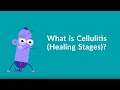 Cellulitis Healing Stages