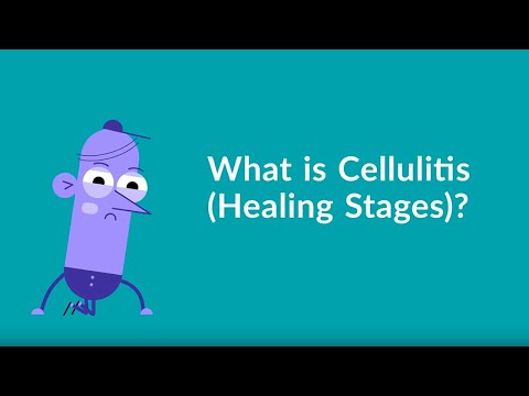 Video: Is preseptale cellulitis pijnlijk?