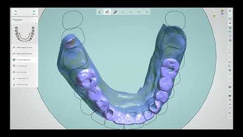 How to use Straumann® RevEX™ scans in 3Shape Dental Designer