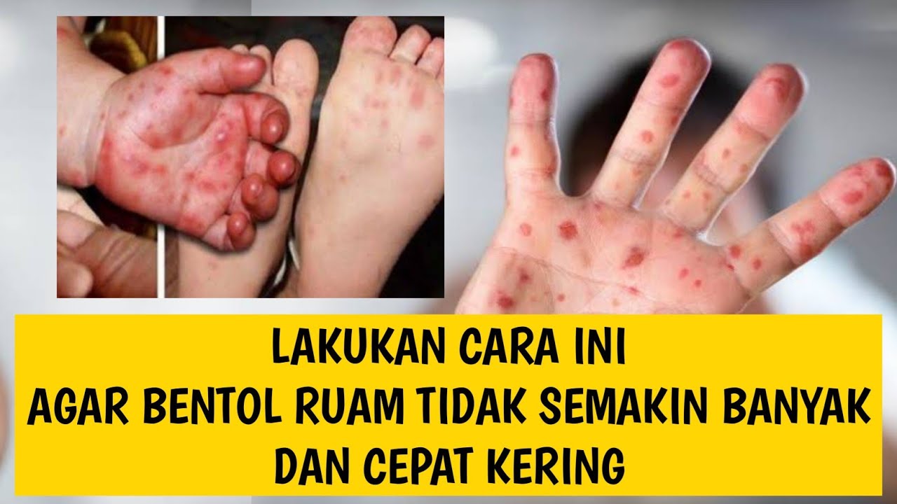 CARA MENGOBATI FLU SINGAPURA PADA ANAK // 2 HARI LANGSUNG KERING 