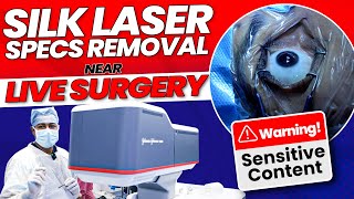 SiLK Laser Specs Removal - Near LIVE Surgery by Dr. Rahil Chaudhary