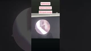 hysteroscopy septum resection bipolar energy saline resectoscope