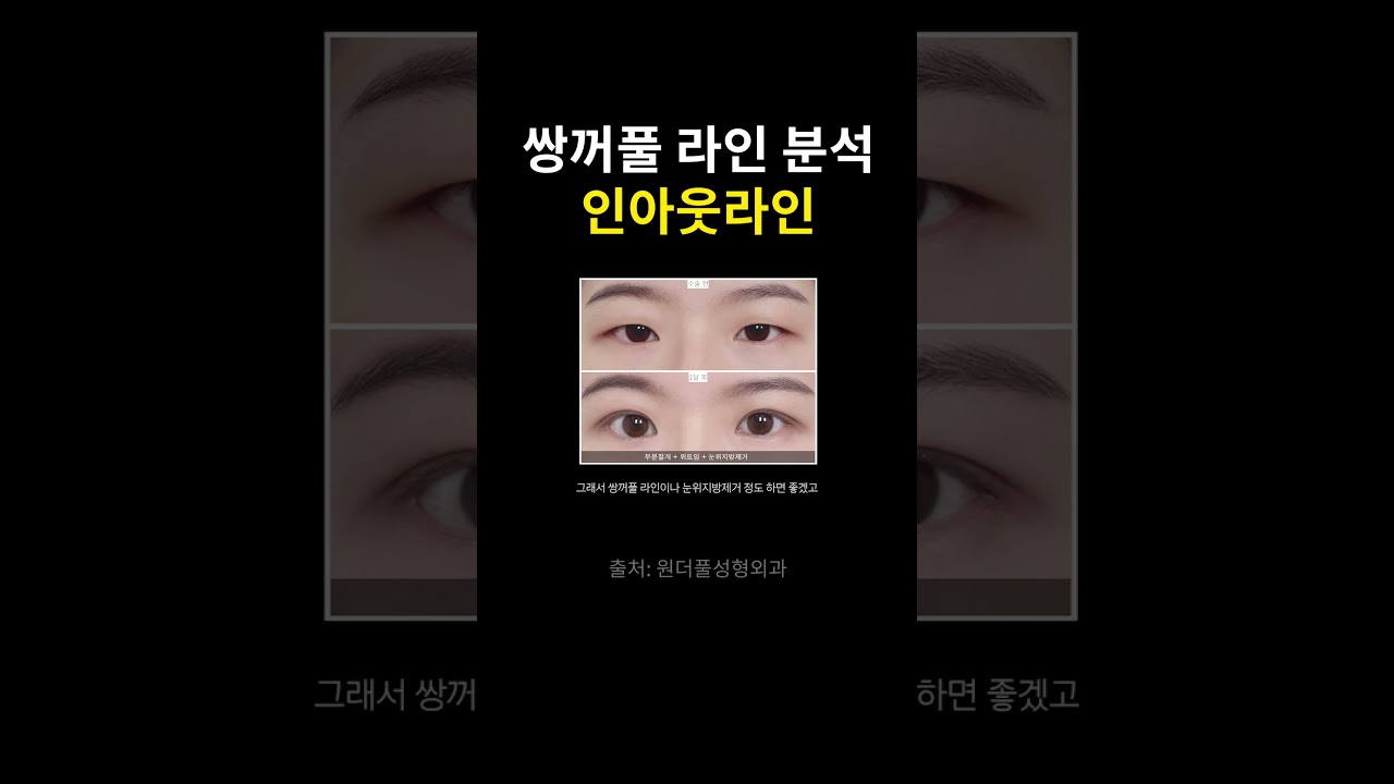 [Вондерфүл Гоо сайхны мэс заслын эмнэлэг] Сүүлийн үед моод болж буй давхрааны хэлбэр юу вэ?