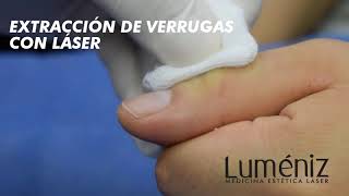 EXTRACCIÓN DE VERRUGAS con láser