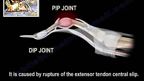 Boutonniere Deformity - Everything You Need To Know - Dr. Nabil Ebraheim