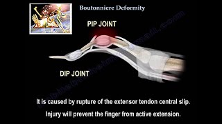 Boutonniere Deformity - Everything You Need To Know - Dr. Nabil Ebraheim