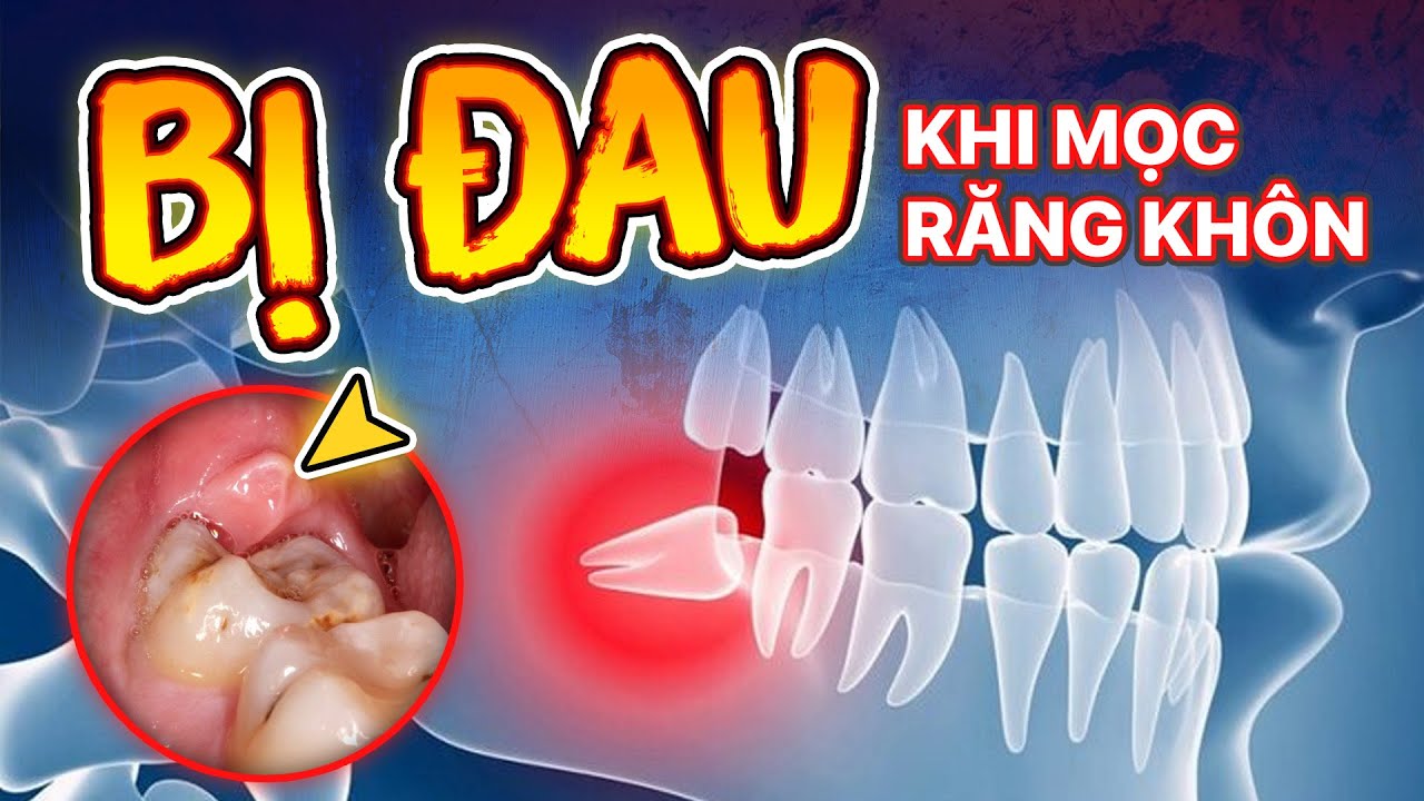Outline Video Mọc Răng Khôn: 7 Dấu Hiệu - 3 Triệu Chứng Nguy Hiểm Và 5 Cách Giảm Đau Tại Nhà Khi Mọc Răng Khôn