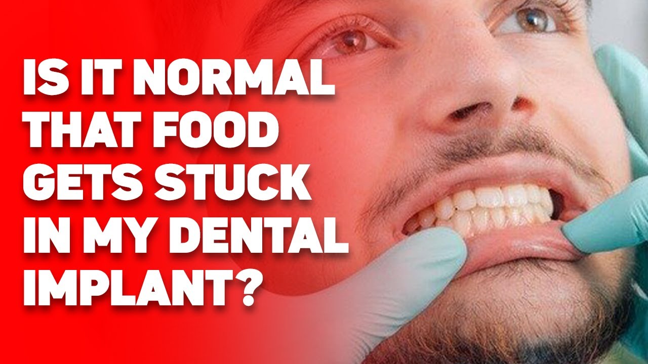 Is it normal that food gets stuck in my dental implant? YouTube