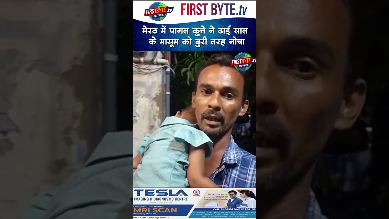 मेरठ में पागल कुत्ते ने ढाई साल के मासूम को बुरी तरह नोचा #meerut #straydogs #shorts #dogbitecases