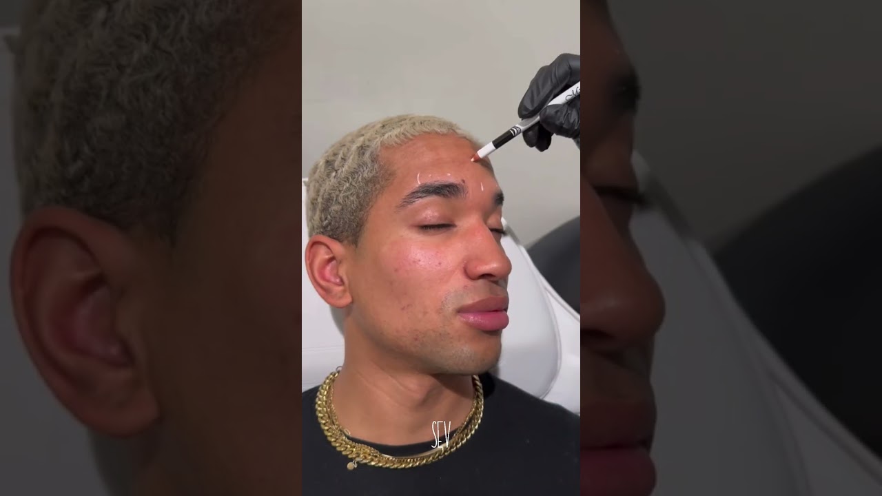 Brotox at SEV for Youthful Skin!