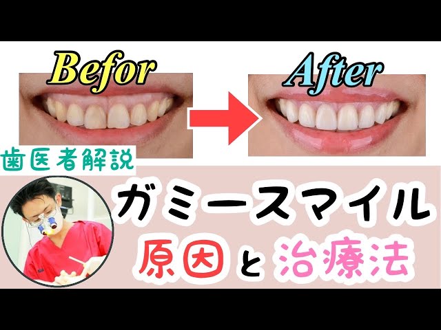 ガミースマイル】気になる見た目の原因と最新の治療法【現役歯科医師