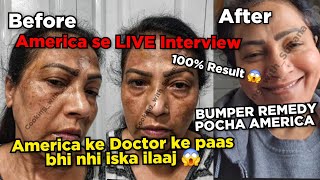 America se LIVE interview | america ke doctor ke pass bhi nahi iska ilaaj | Cooking with Sultana 