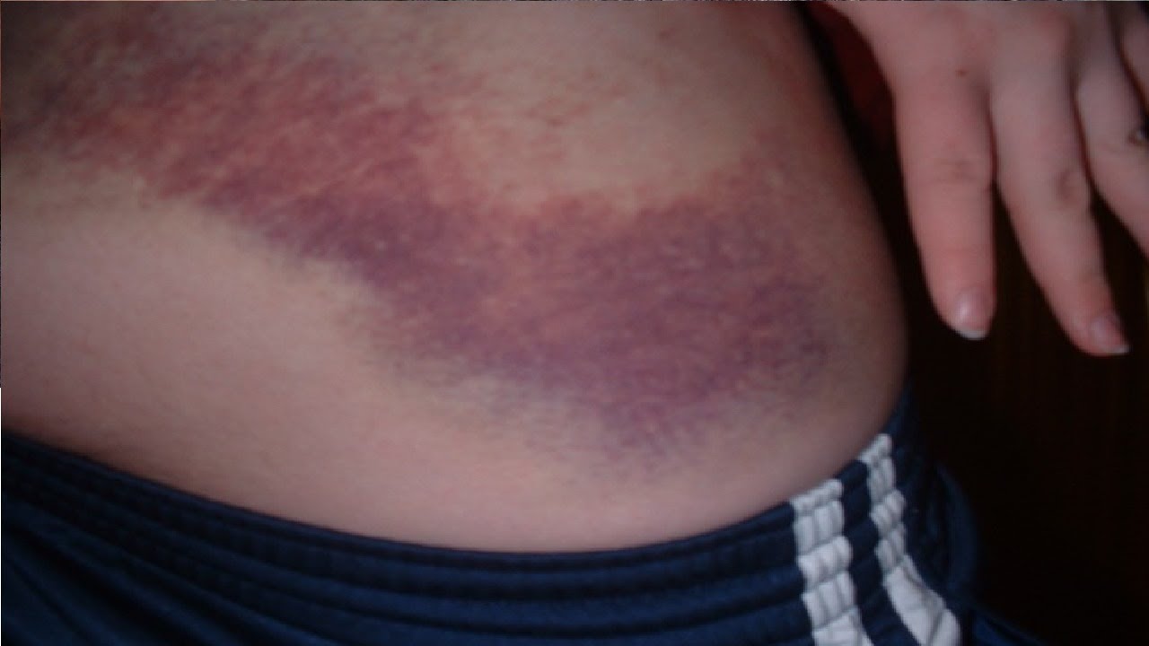 how to get rid of a charley horse in hip YouTube