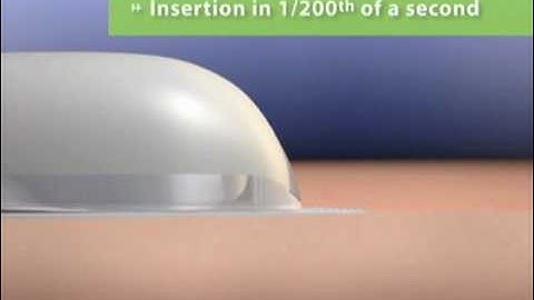 How OmniPod Auto-Insertion Works