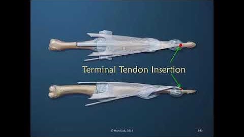 Understanding the Dorsal Apparatus of the Finger; Part 9 of 11: Terminal Tendon Insertion