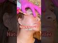EZ GEL PRF Natural Filler Made From YOUR Blood Newport Beach Results 