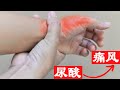 尿酸的“克星”原来就在身边!多吃这7样,开启人体“降酸”模式