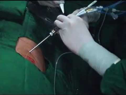 Flexible scopy with microperc & miniperc Jogendrasingh