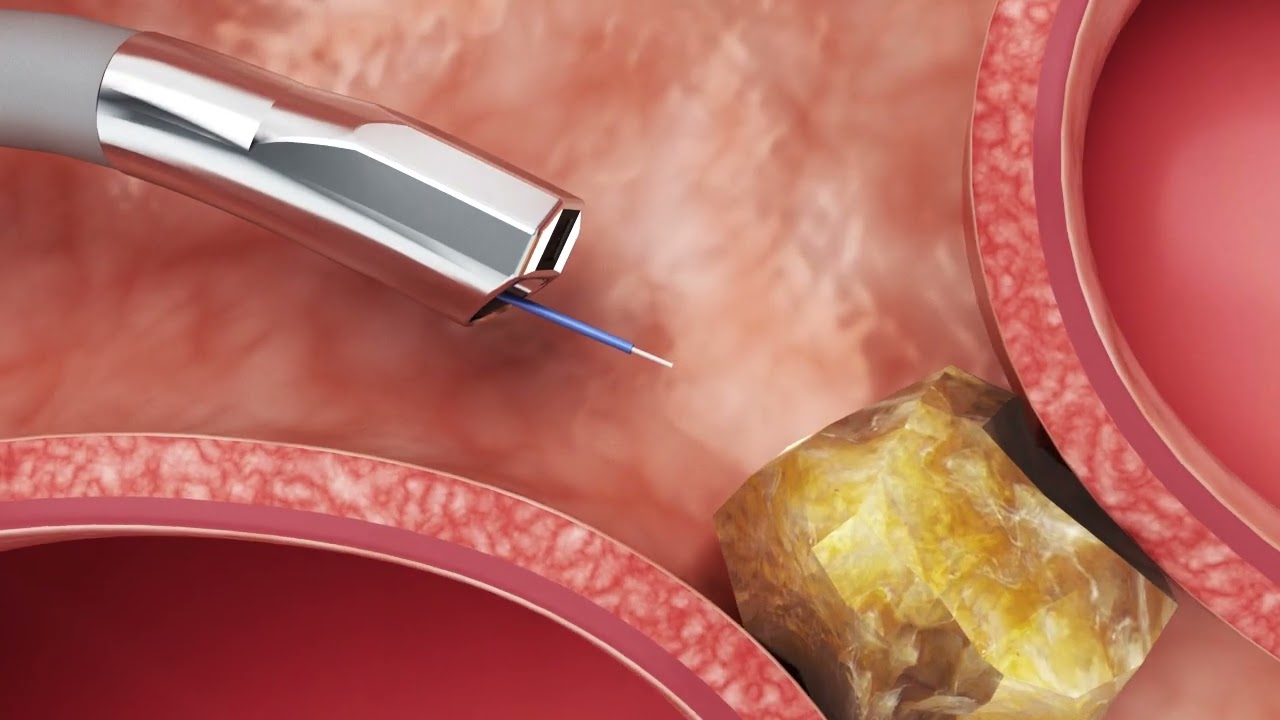 Kidney Stone Ablation Using Quantino -  75W Thulium Fiber Laser | Marflow AG