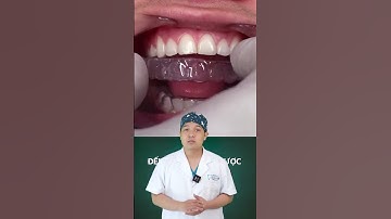 Niềng Răng Thì Đeo Hàm Duy Trì Trong Bao Lâu? | Kiến Thức Niềng Răng