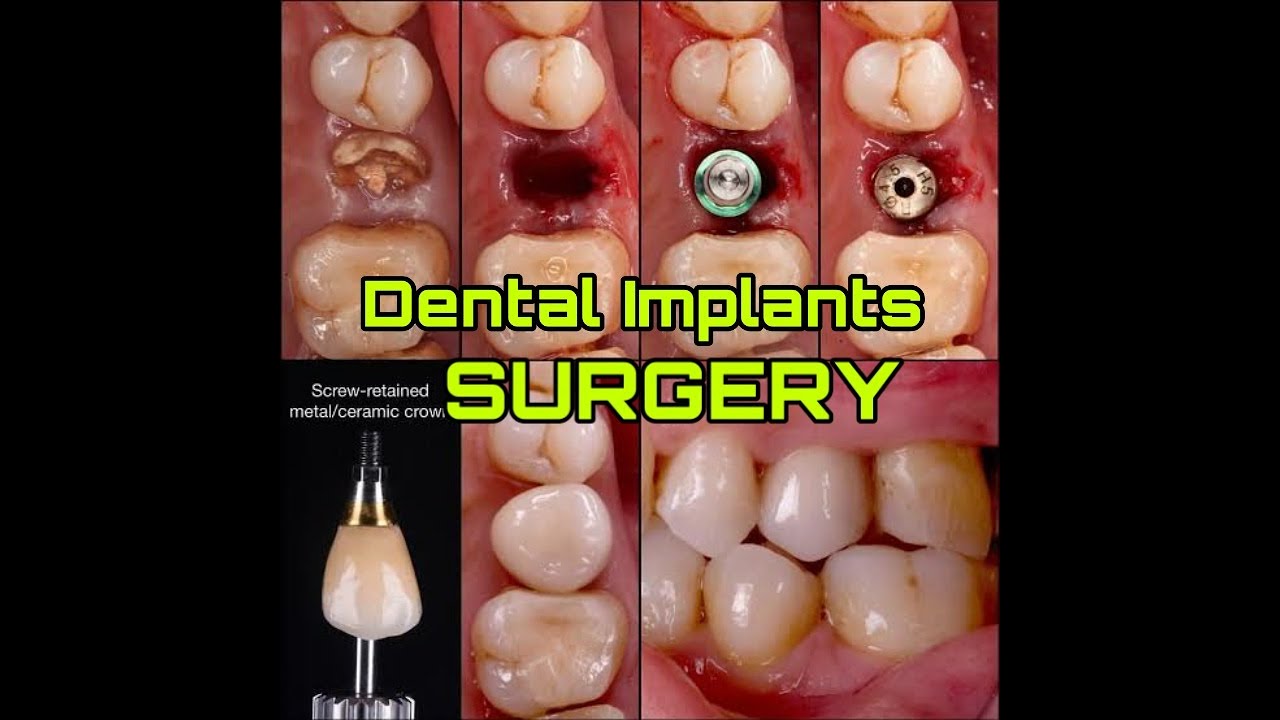 Dental Implant Surgery, Repair, Perforation & Sinus Lift Dr. Yaseen