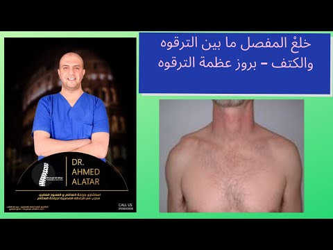 خلع المفصل ما بين الترقوه والكتف بروز عظمة الترقوه