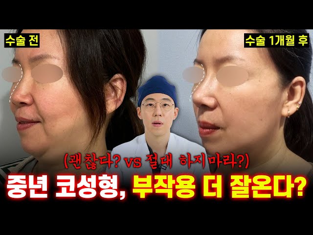 중년 코성형, 부작용 더 잘온다..? | ✨중년 코 성형 걱정 완벽 해결 영상✨