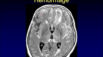 Diffuse Sulcal FLAIR signal abnormality
